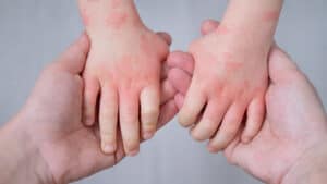 A child's journey with eczema: visible on their small hands, waiting for soothing solutions.